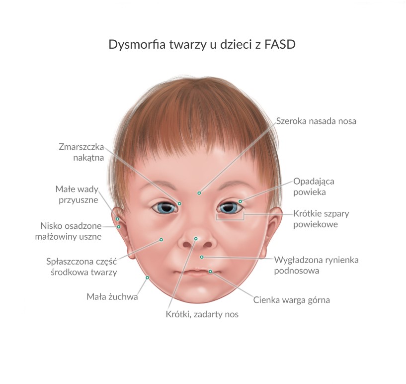 Na grafice przedstawione zostały wszystkie wady rozwojowe dysmorfii twarzy związane z płodowym zespołem alkoholowym i dzieci. 