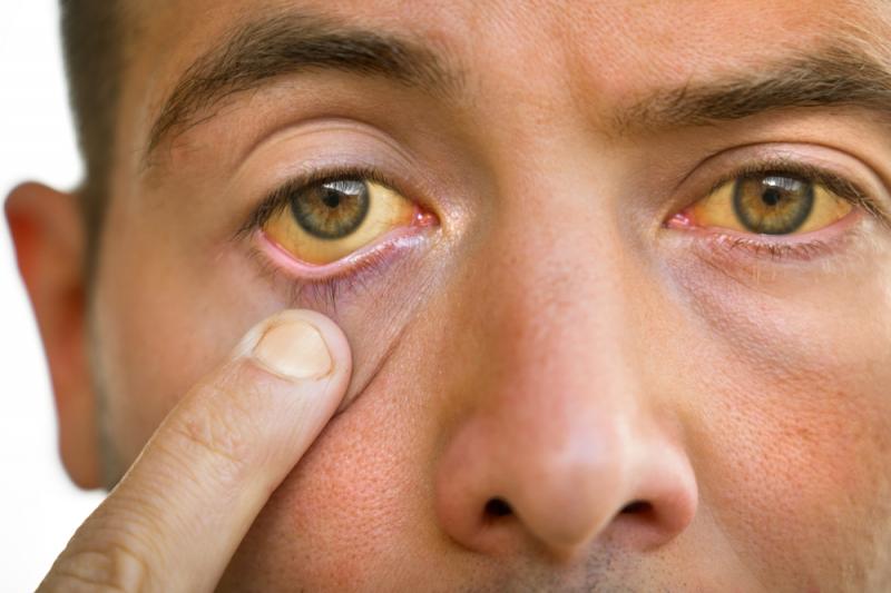 Na zdjęciu widoczna twarz mężczyzny, który palcem odchyla dolną powiekę oka. Białka w oku oraz jego skóra jest zabarwiona na żółto, co świadczy o złej pracy wątroby. Kadr wąski. 